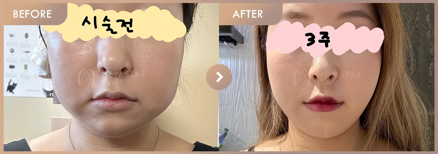 Energy-based lifting before-and-after photos at Newstar Clinic