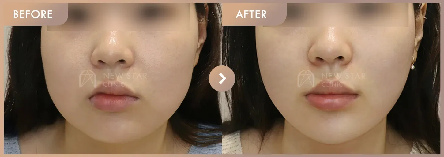 ONDA lifting · 01 before-and-after photos at Newstar Clinic