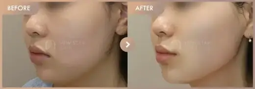 ONDA lifting · 02: before-and-after comparison at Newstar Clinic