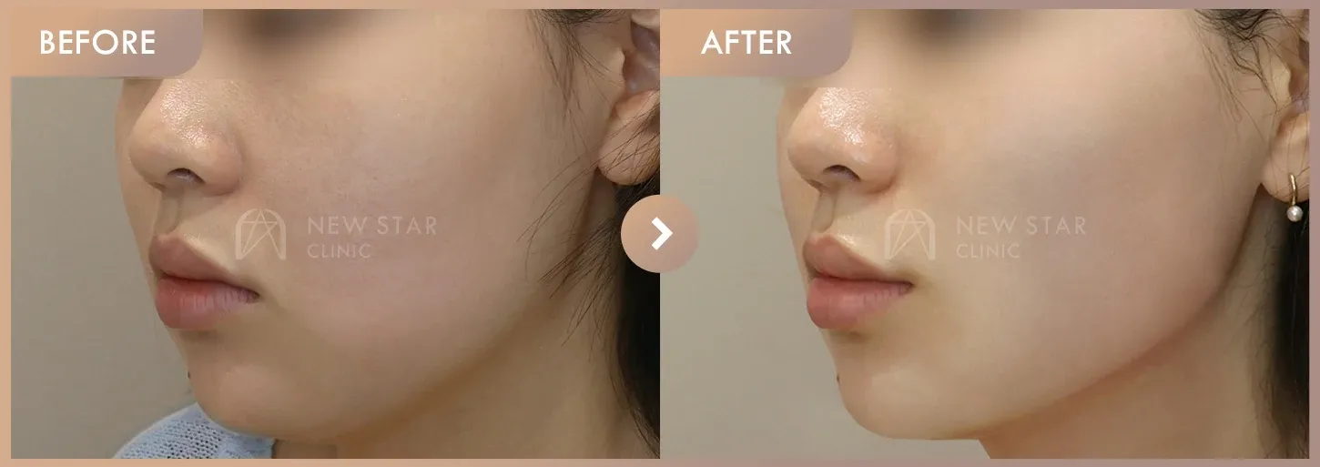 ONDA lifting · 02 before-and-after photos at Newstar Clinic