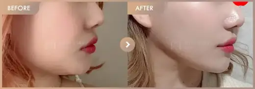 Energy-based lifting: before-and-after comparison at Newstar Clinic