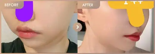 Energy-based lifting: before-and-after comparison at Newstar Clinic