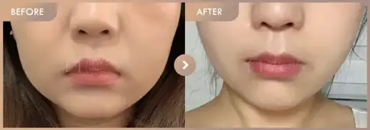 ONDA lifting · Front view: before-and-after comparison at Newstar Clinic