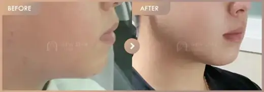 ONDA lifting: before-and-after comparison at Newstar Clinic