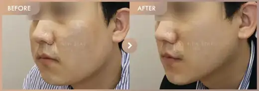 InMode + ONDA lifting: before-and-after comparison at Newstar Clinic