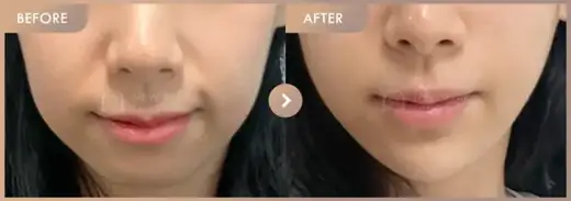 Energy-based lifting: before-and-after comparison at Newstar Clinic