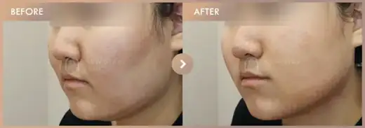 ONDA lifting 5 sessions + Thread lifting · 01: before-and-after comparison at Newstar Clinic