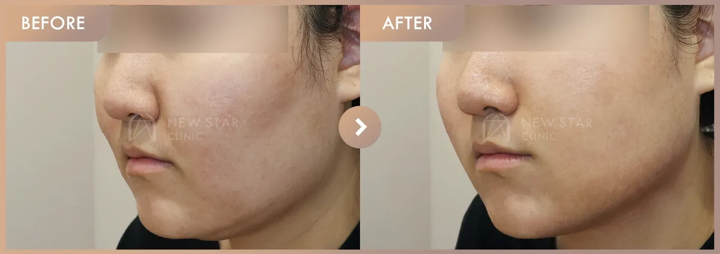 ONDA lifting 5 sessions + Thread lifting · 01 before-and-after photos at Newstar Clinic