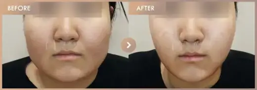 ONDA lifting 5 sessions + Thread lifting · 02: before-and-after comparison at Newstar Clinic