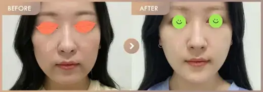 ONDA lifting + Chin filler: before-and-after comparison at Newstar Clinic