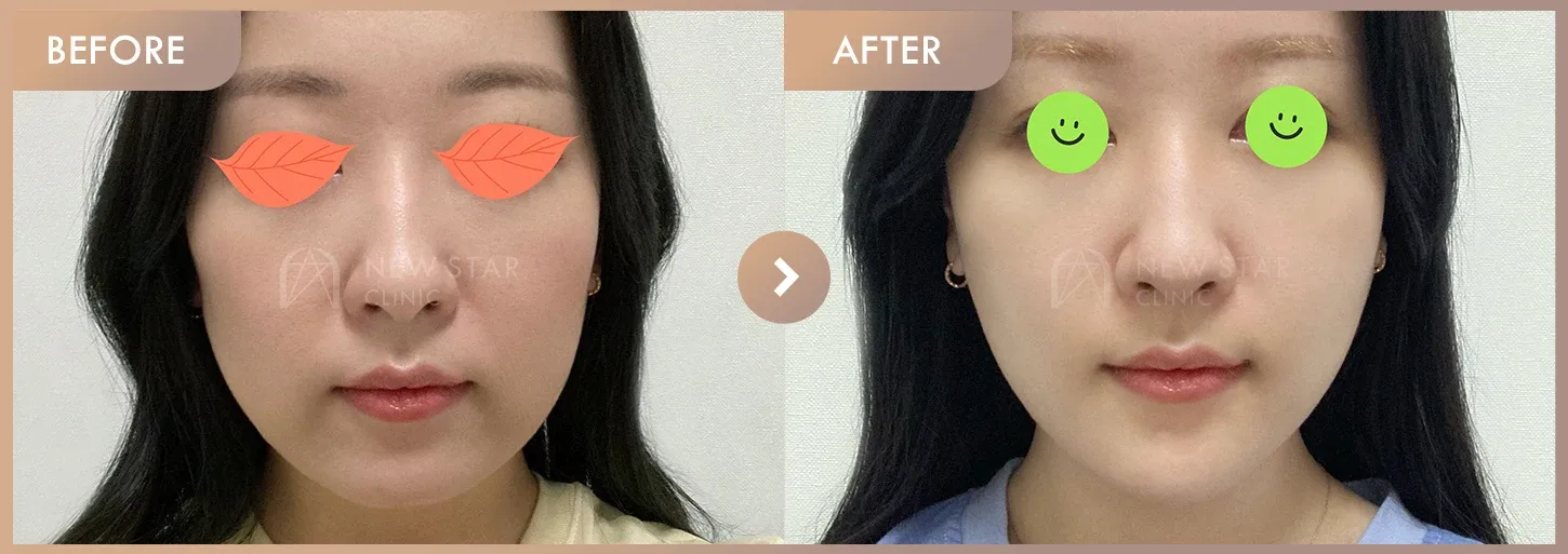 ONDA lifting + Chin filler before-and-after photos at Newstar Clinic
