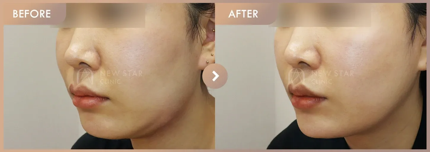 ONDA lifting · 01 before-and-after photos at Newstar Clinic