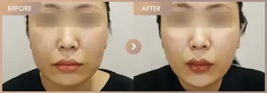 ONDA lifting · 02: before-and-after comparison at Newstar Clinic