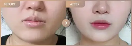 ONDA lifting: before-and-after comparison at Newstar Clinic