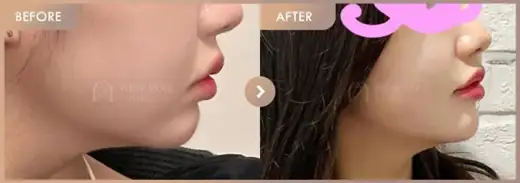 ONDA lifting + Chin filler: before-and-after comparison at Newstar Clinic
