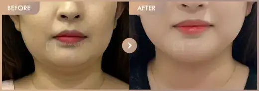 ONDA lifting: before-and-after comparison at Newstar Clinic