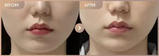 ONDA lifting: before-and-after comparison at Newstar Clinic