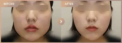 ONDA lifting 5 sessions: before-and-after comparison at Newstar Clinic