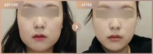 ONDA lifting: before-and-after comparison at Newstar Clinic