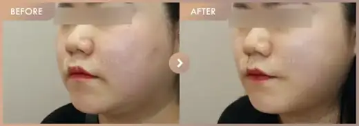 ONDA lifting: before-and-after comparison at Newstar Clinic