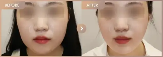 Energy-based lifting: before-and-after comparison at Newstar Clinic