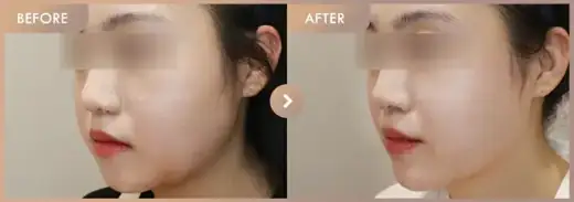 Energy-based lifting: before-and-after comparison at Newstar Clinic