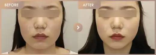 ONDA lifting: before-and-after comparison at Newstar Clinic