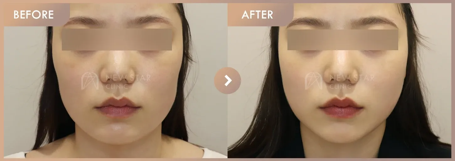 ONDA lifting before-and-after photos at Newstar Clinic
