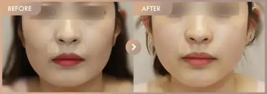 ONDA lifting: before-and-after comparison at Newstar Clinic