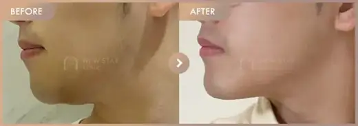 ONDA lifting: before-and-after comparison at Newstar Clinic