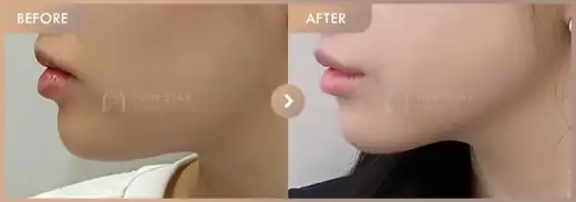 ONDA lifting: before-and-after comparison at Newstar Clinic