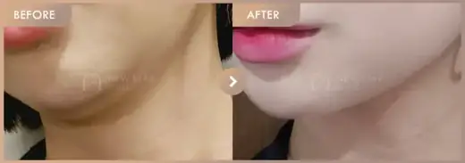 ONDA lifting: before-and-after comparison at Newstar Clinic