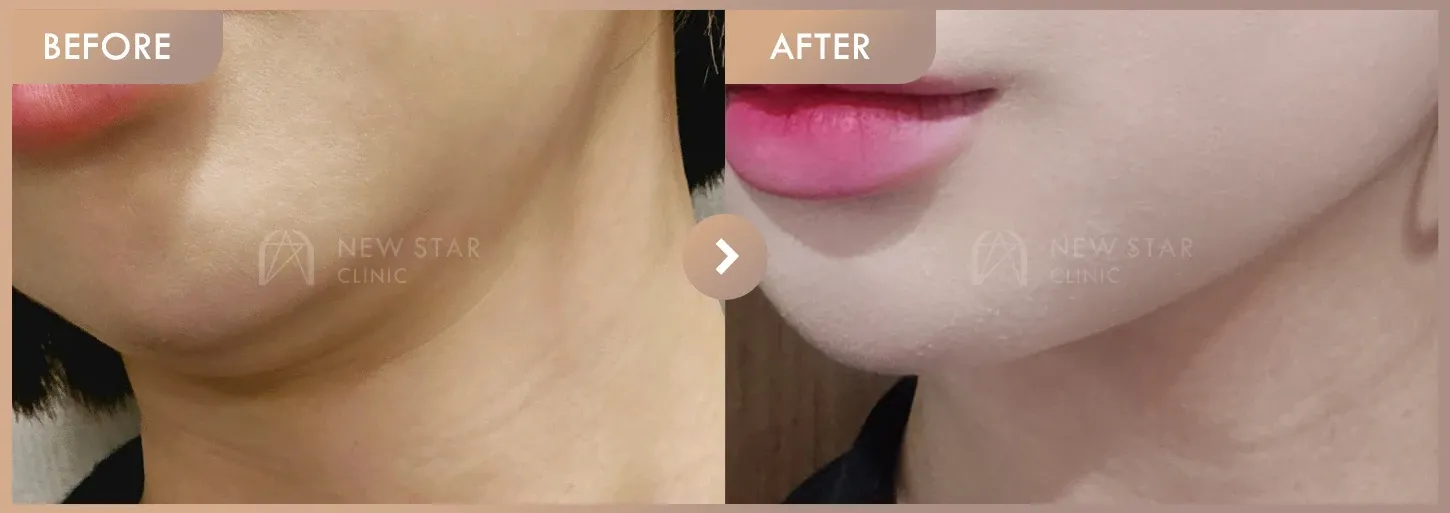 ONDA lifting before-and-after photos at Newstar Clinic
