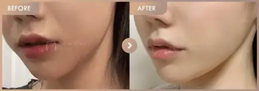 ONDA lifting: before-and-after comparison at Newstar Clinic