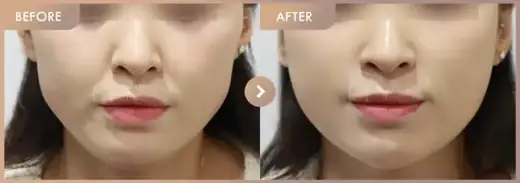 Energy-based lifting: before-and-after comparison at Newstar Clinic