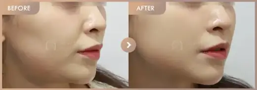 Energy-based lifting: before-and-after comparison at Newstar Clinic