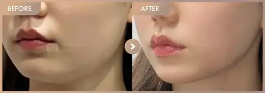 ONDA lifting 3 sessions: before-and-after comparison at Newstar Clinic