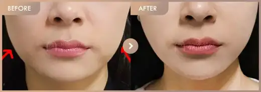ONDA lifting: before-and-after comparison at Newstar Clinic