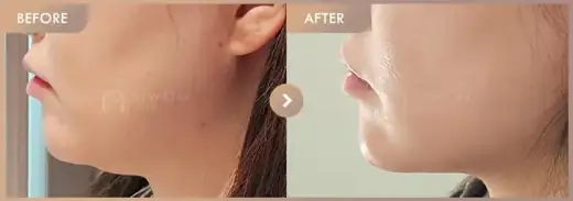 ONDA lifting: before-and-after comparison at Newstar Clinic