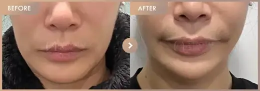 ONDA lifting 3 sessions: before-and-after comparison at Newstar Clinic