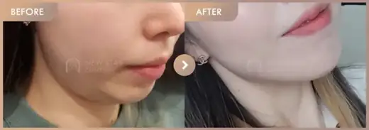 InMode FX + FORMA: before-and-after comparison at Newstar Clinic