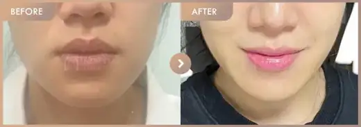 ONDA lifting 3 sessions: before-and-after comparison at Newstar Clinic