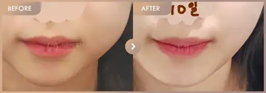 ONDA lifting: before-and-after comparison at Newstar Clinic