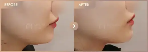InMode FX + FORMA: before-and-after comparison at Newstar Clinic