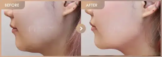 ONDA lifting: before-and-after comparison at Newstar Clinic
