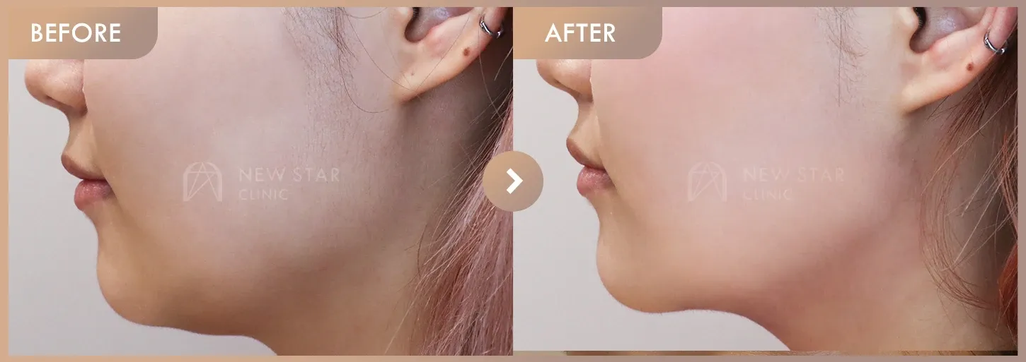 ONDA lifting before-and-after photos at Newstar Clinic