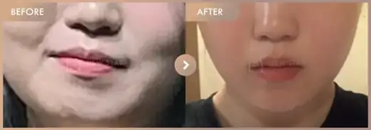 ONDA lifting 2 sessions: before-and-after comparison at Newstar Clinic
