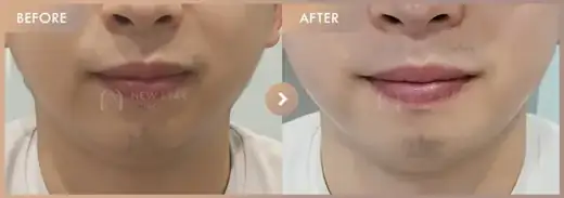 ONDA lifting: before-and-after comparison at Newstar Clinic