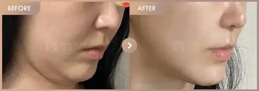ONDA lifting: before-and-after comparison at Newstar Clinic