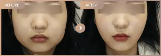 ONDA lifting: before-and-after comparison at Newstar Clinic